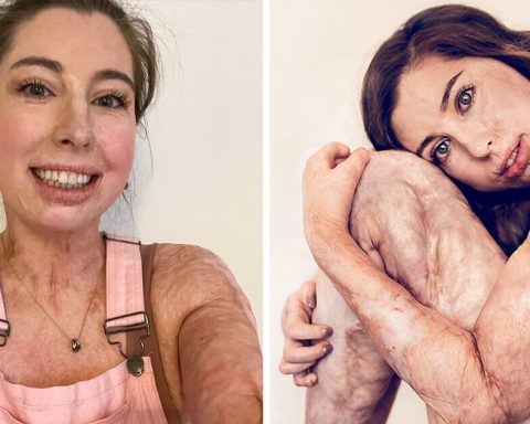 The Story of a Woman Who Survived Burns on 96% of Her Body and Shook Up the Beauty Industry
