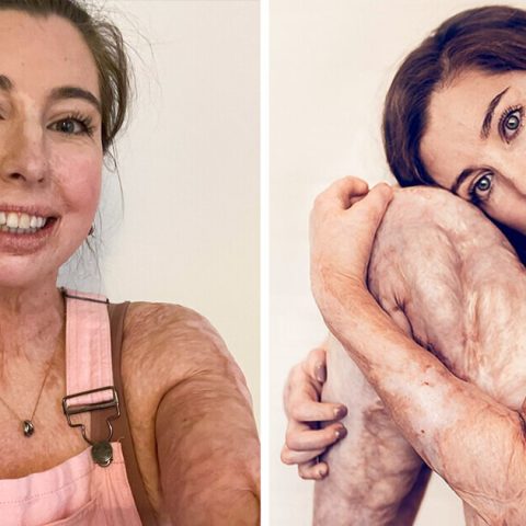The Story of a Woman Who Survived Burns on 96% of Her Body and Shook Up the Beauty Industry