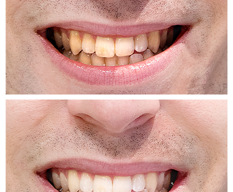 This Teeth Whitening Prewash May Leave You 6 Shades Lighter in 5 Days